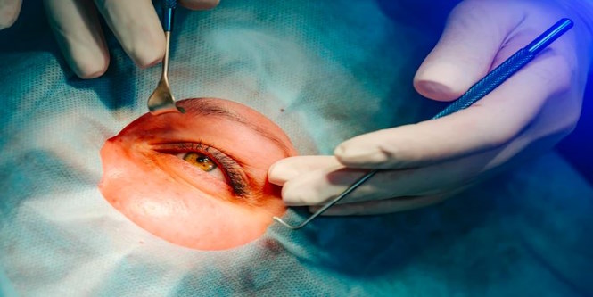 A Legal Expert's Guide to Laser Eye Surgery